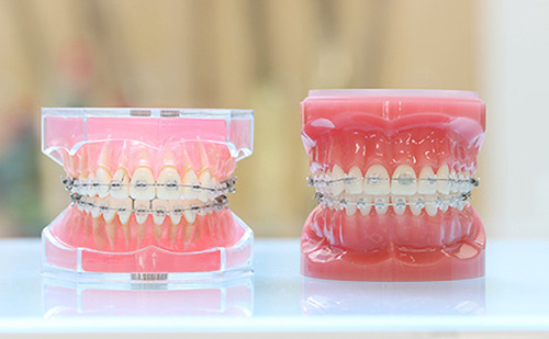 ブラケット矯正